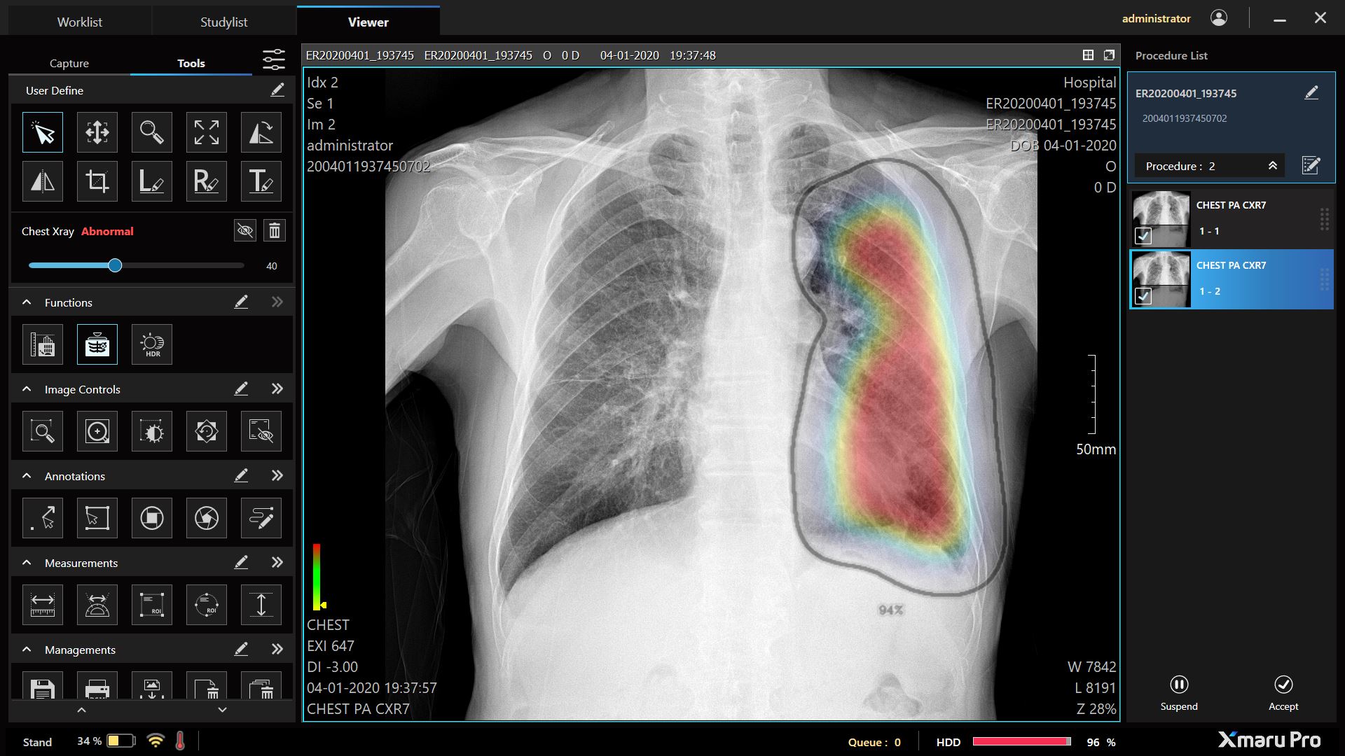레이언스의 엑스마루 프로가 AI로 검출한 폐렴 관련 소견.JPG